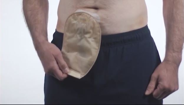 a close-up of a man with an ostomy pouch