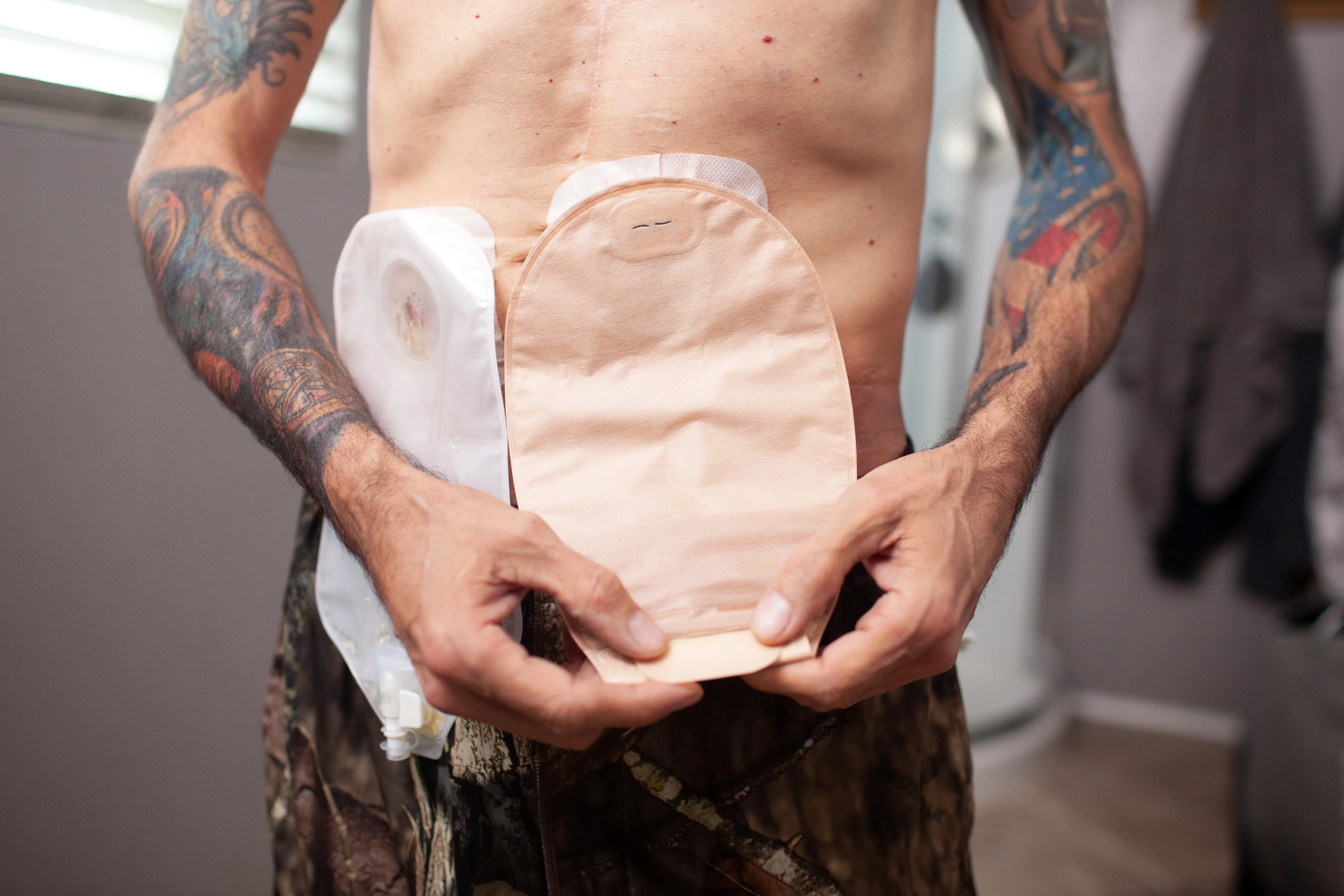 um homem com uma ostomia
