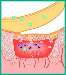 en tegning av hvordan DuoDERM® bandasjer fungerer